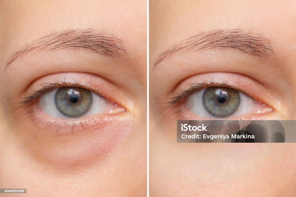 Close-up of the face of a young woman with a bag under her eye before and after treatment. Swelling of the lower eyelid. Removing bruises and dark circles using cosmetics and creams. Blepharoplasty