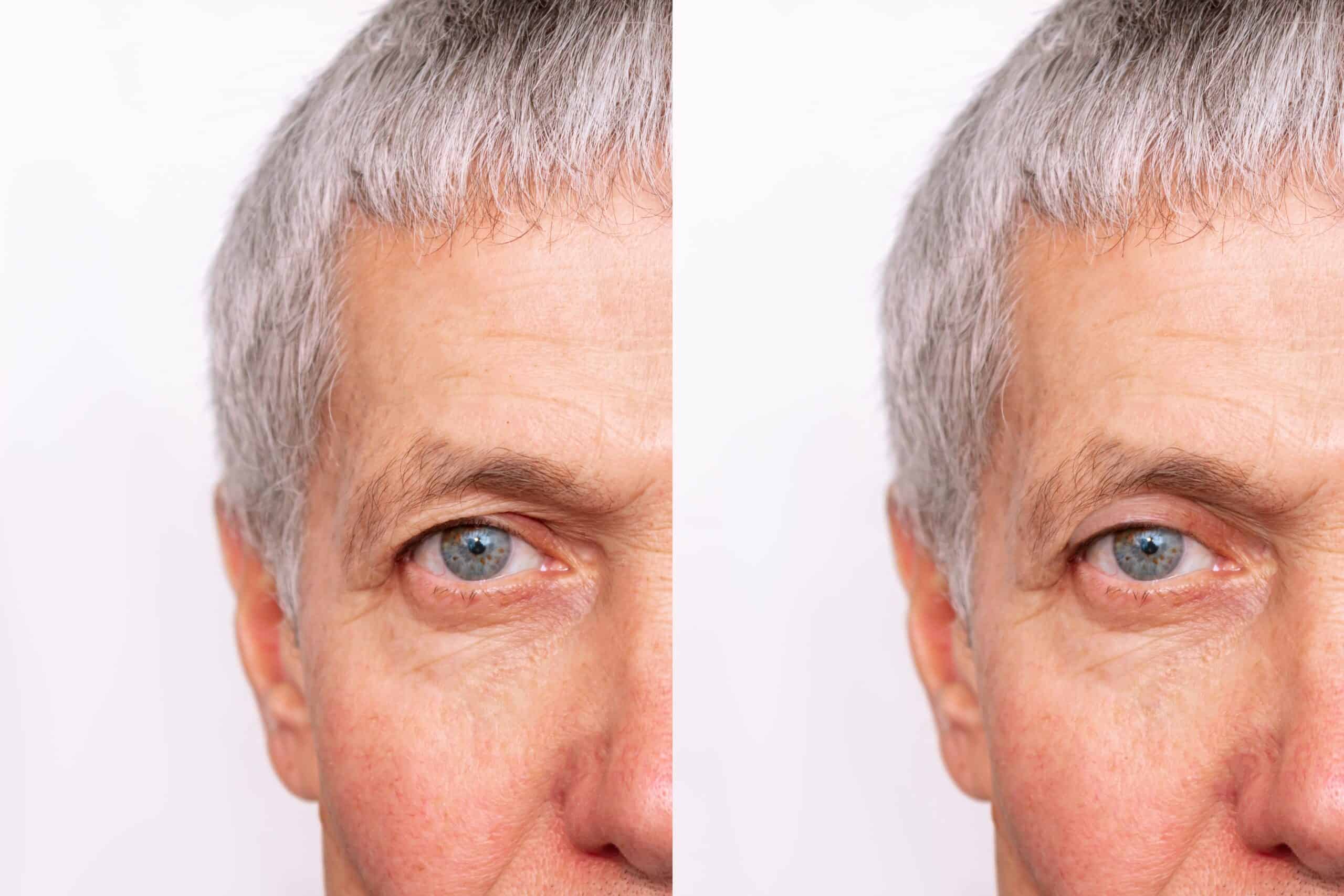 Cropped,Shot,Of,A,Elderly,Caucasian,Man's,Face,With,Drooping