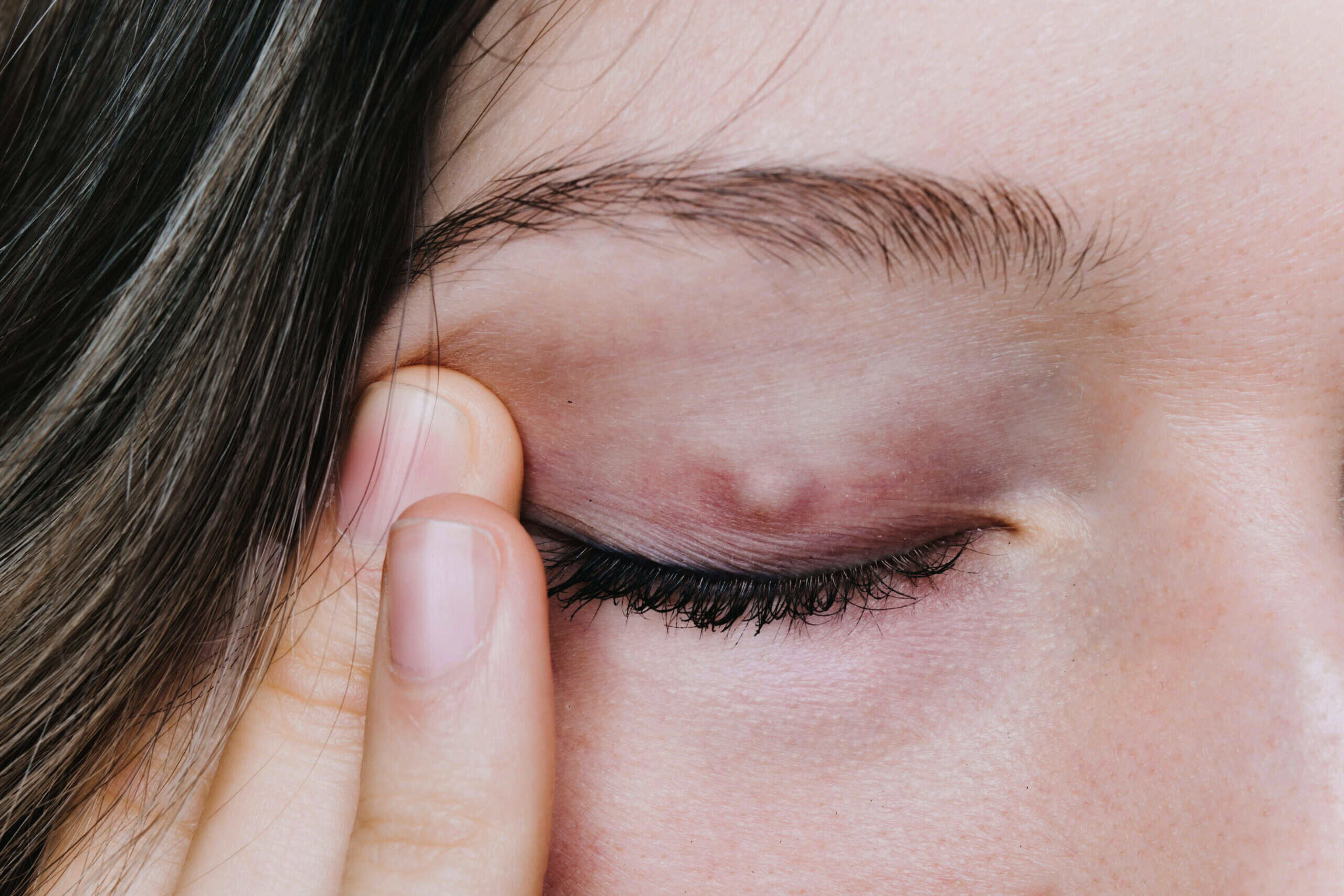 Young,Girl,Shows,A,Chalazion,On,The,Eyelid,Closeup